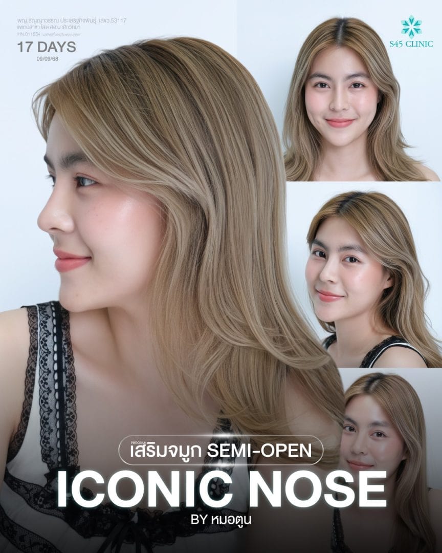 ทรงจมูก ICONIC