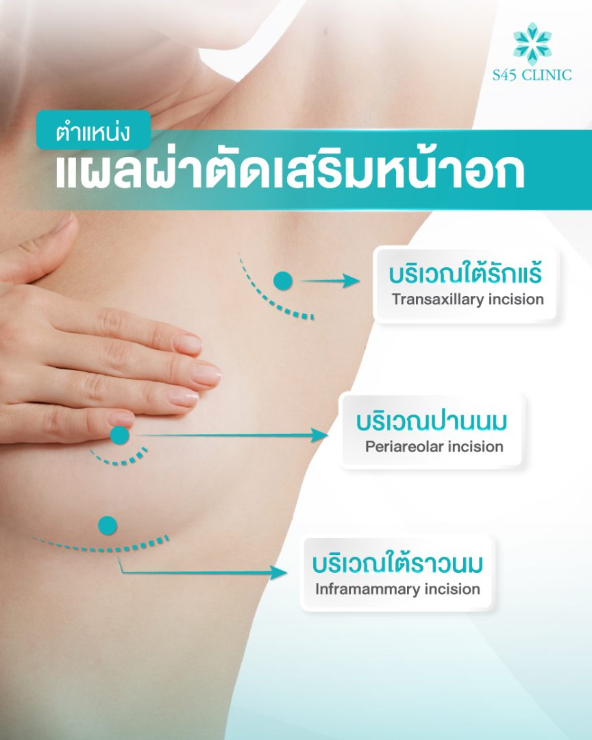 เสริมหน้าอก