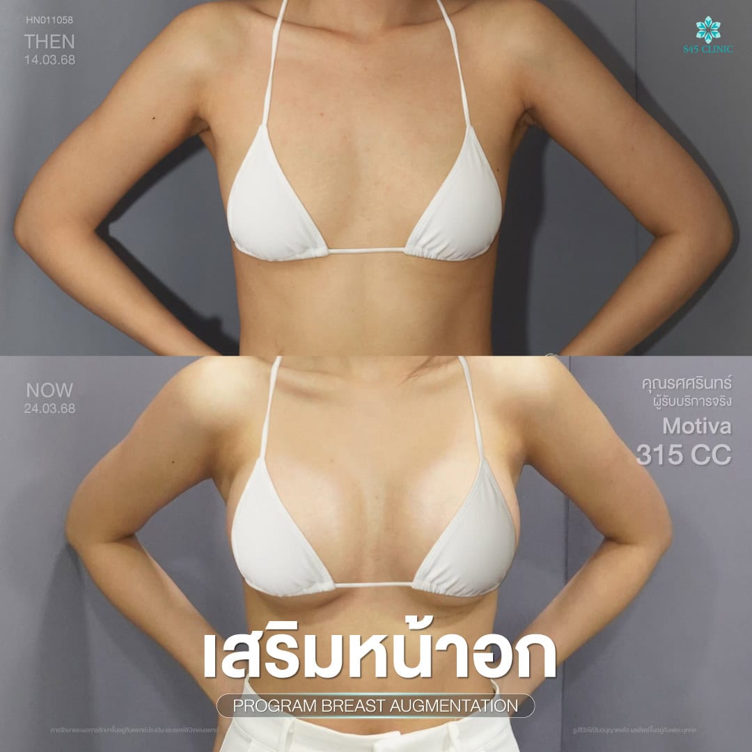 เสริมหน้าอก