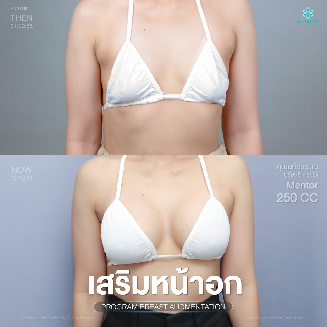 เสริมหน้าอก