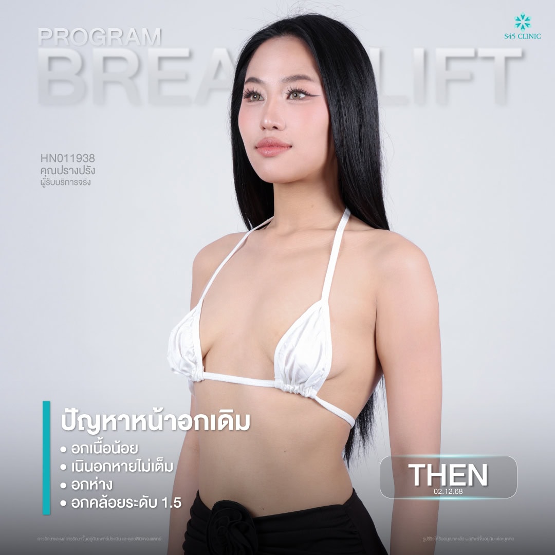 หน้าอกหย่อนคล้อย