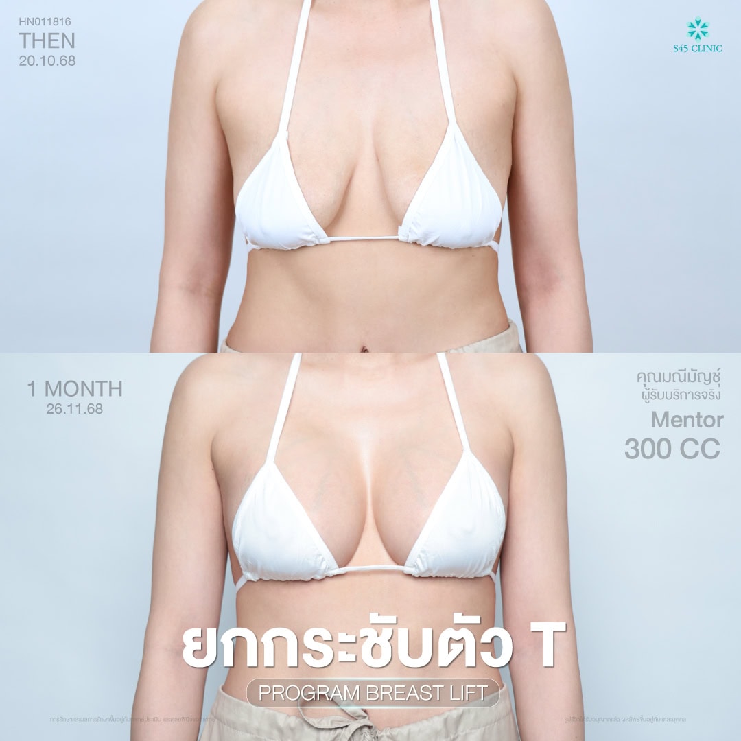 เสริมหน้าอก