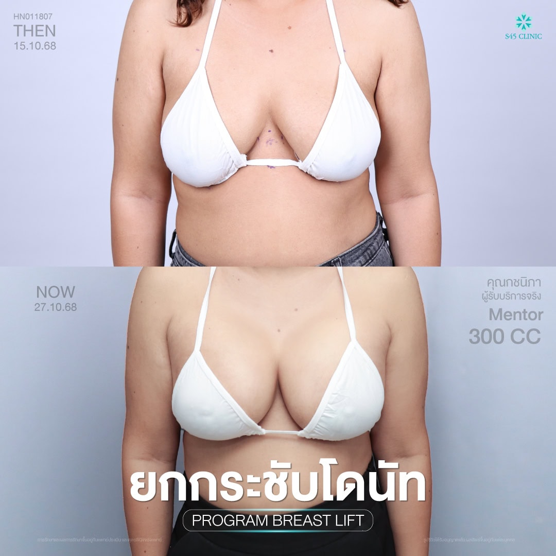 เสริมหน้าอก