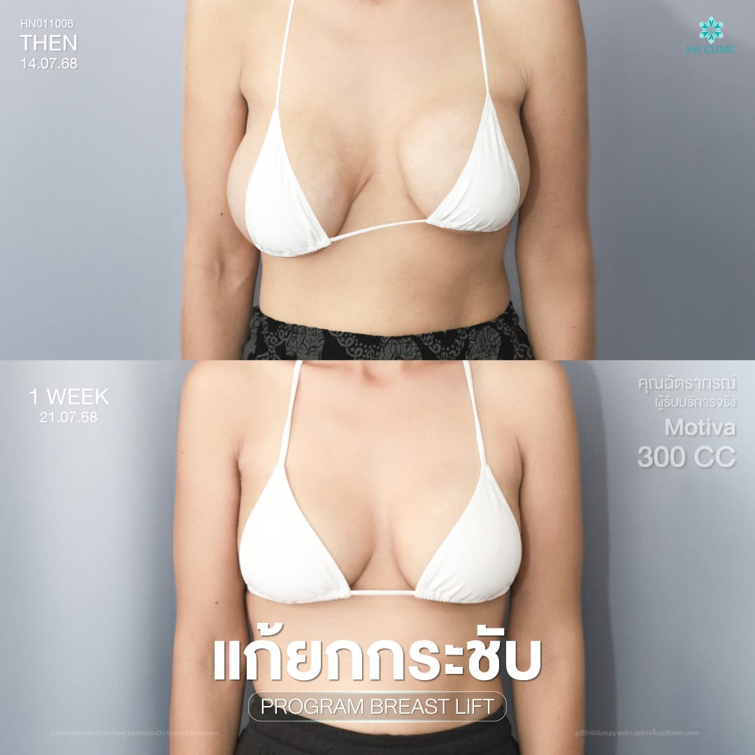 เสริมหน้าอก