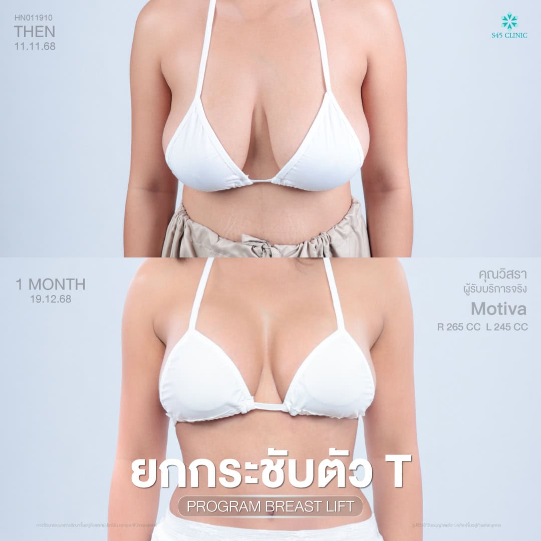 เสริมหน้าอก