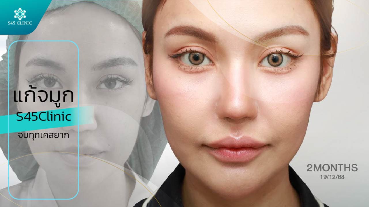 ทำไมต้องแก้จมูก s45clinic