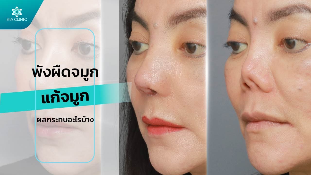 พังผืดส่งผลอะไรต่อการเสริมจมูก