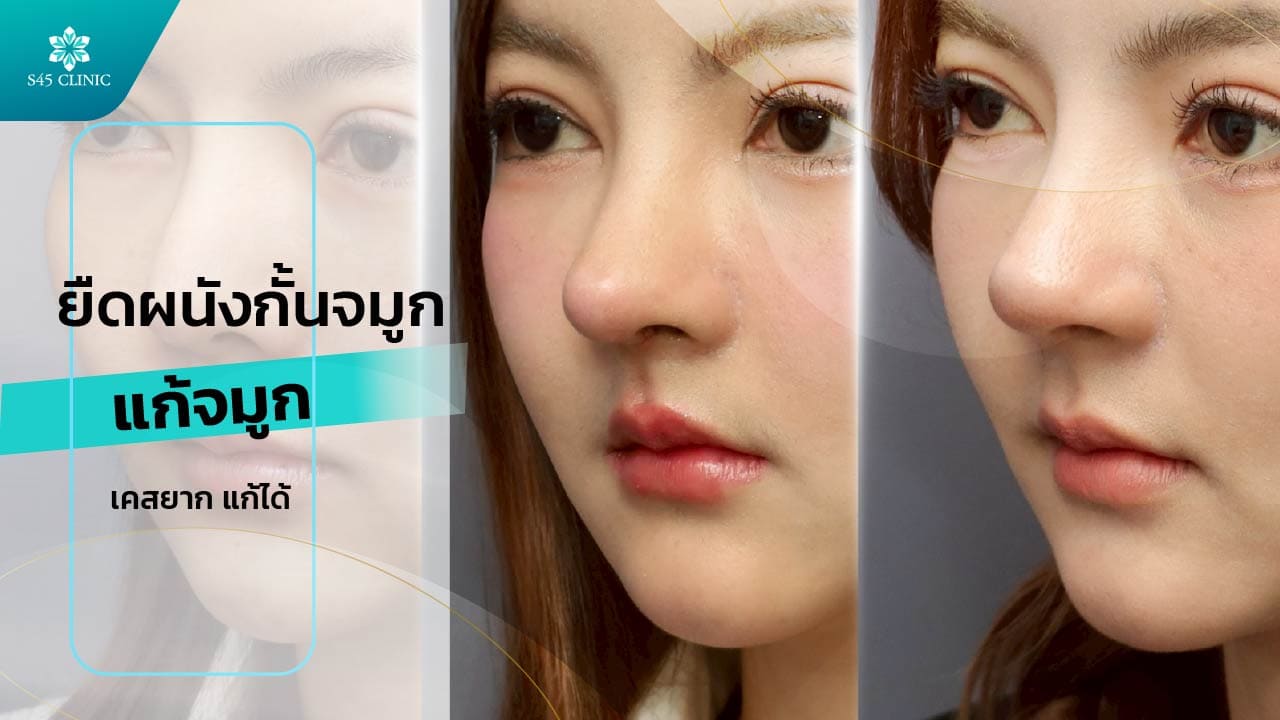 ยืดผนังกั้นจมูก แก้จมูกเคสยาก