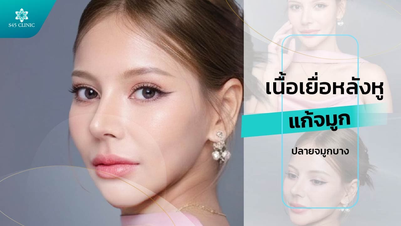 เนื้อเยื่อหลังหู แก้ปลายจมูกบาง