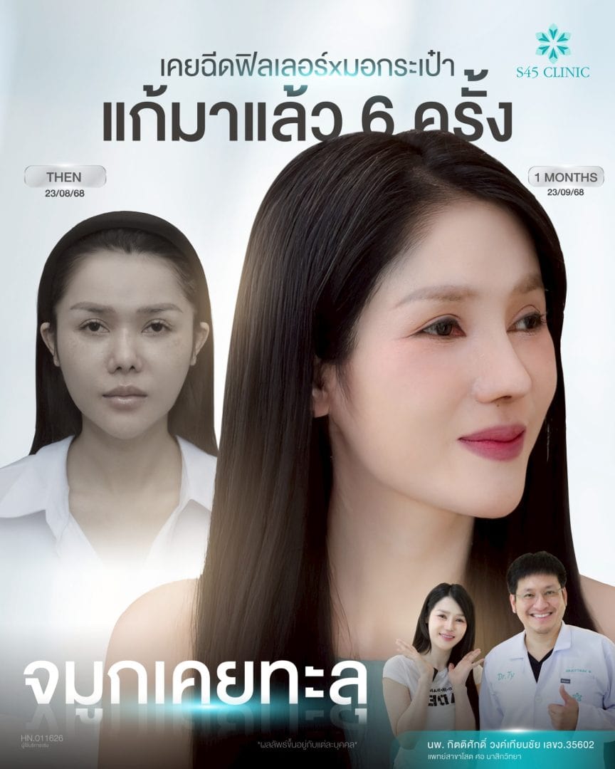 แก้จมูก