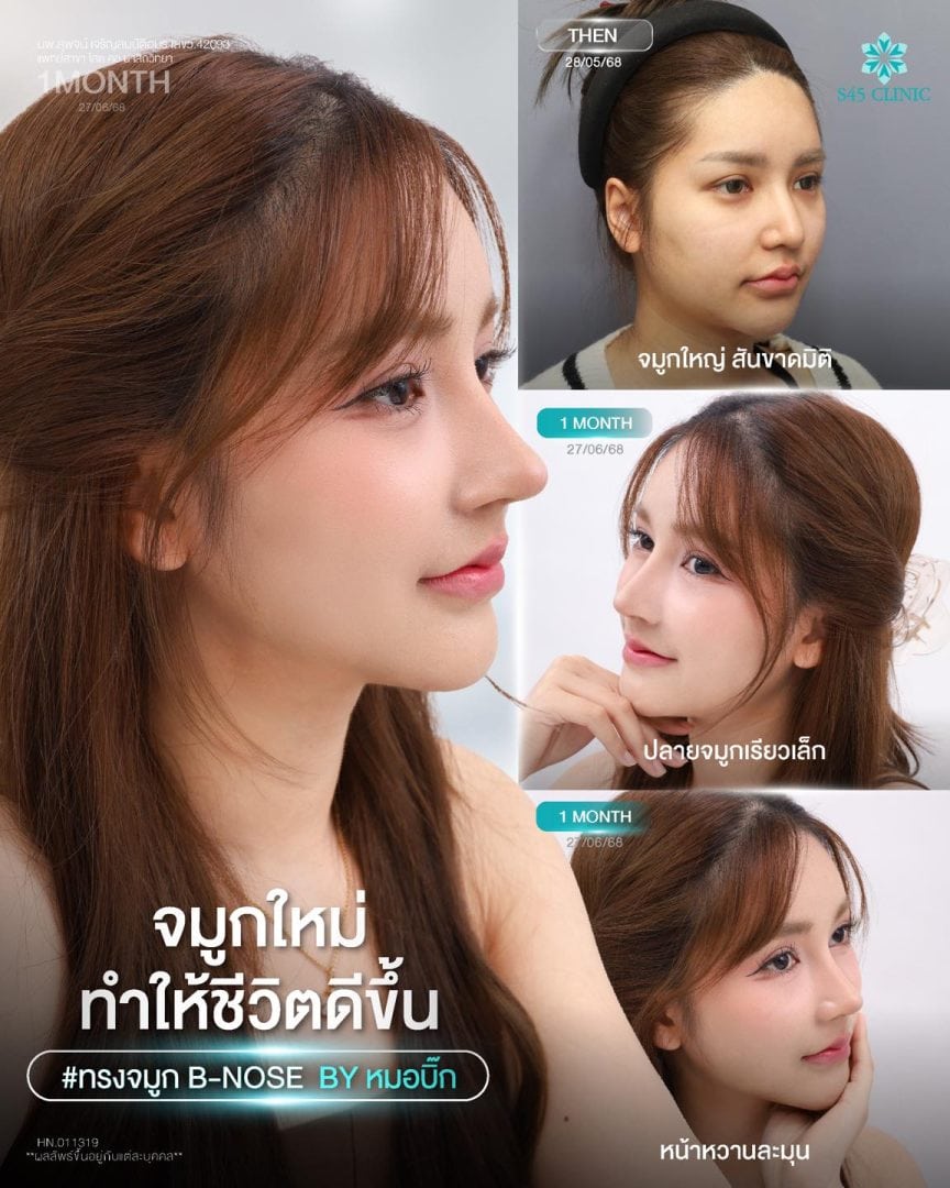 แก้จมูก B-Nose