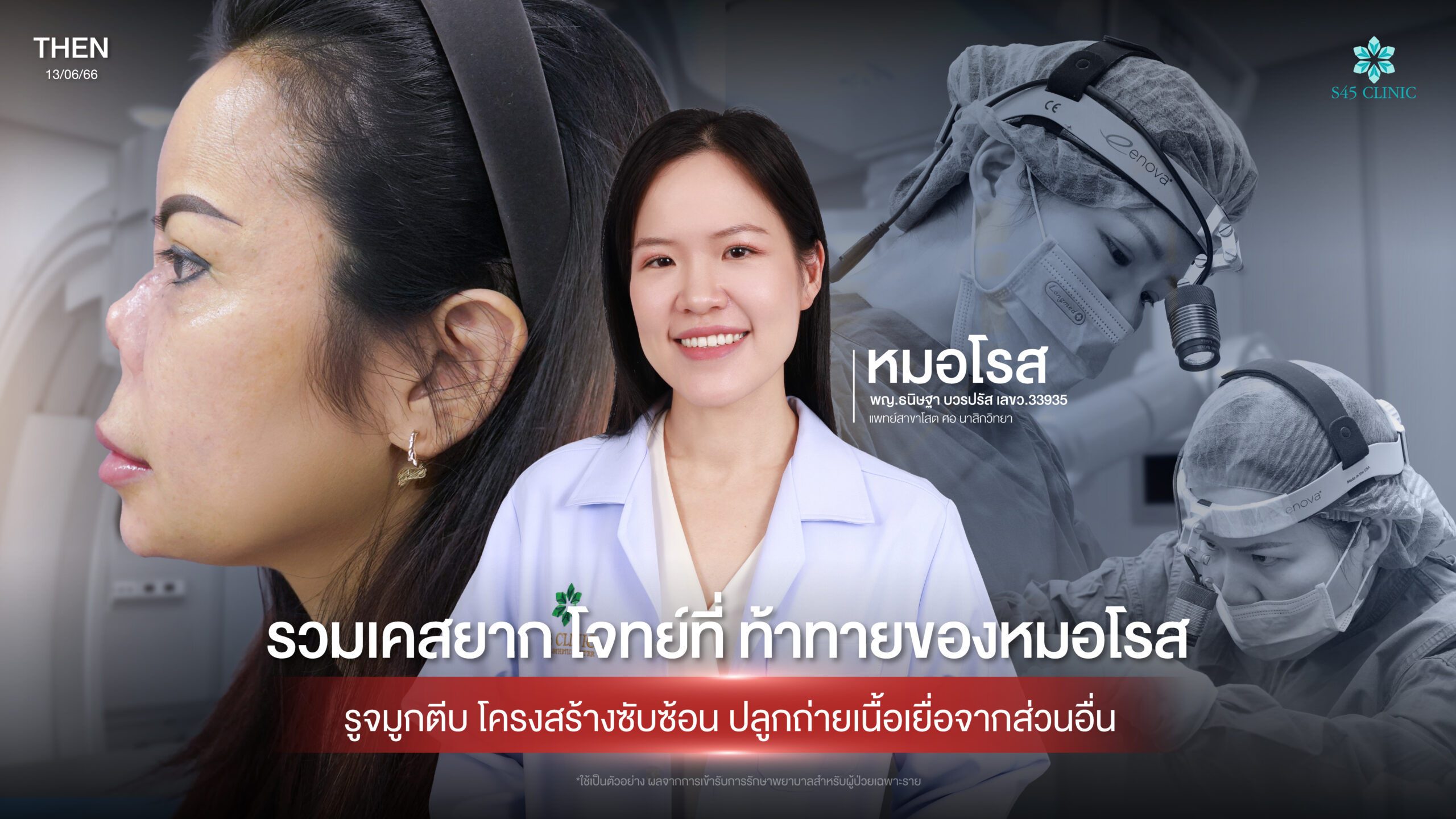 complex-rhinoplasty-revision-s45-clinic