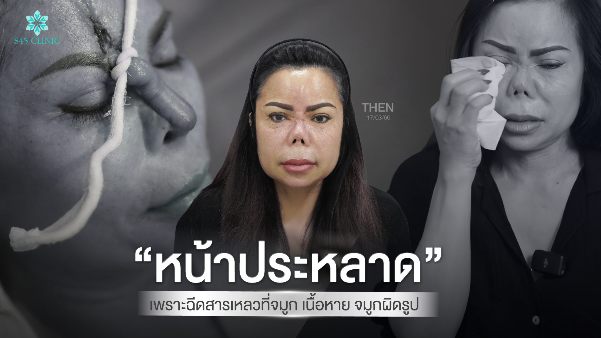 fix-damaged-nose-open-rib