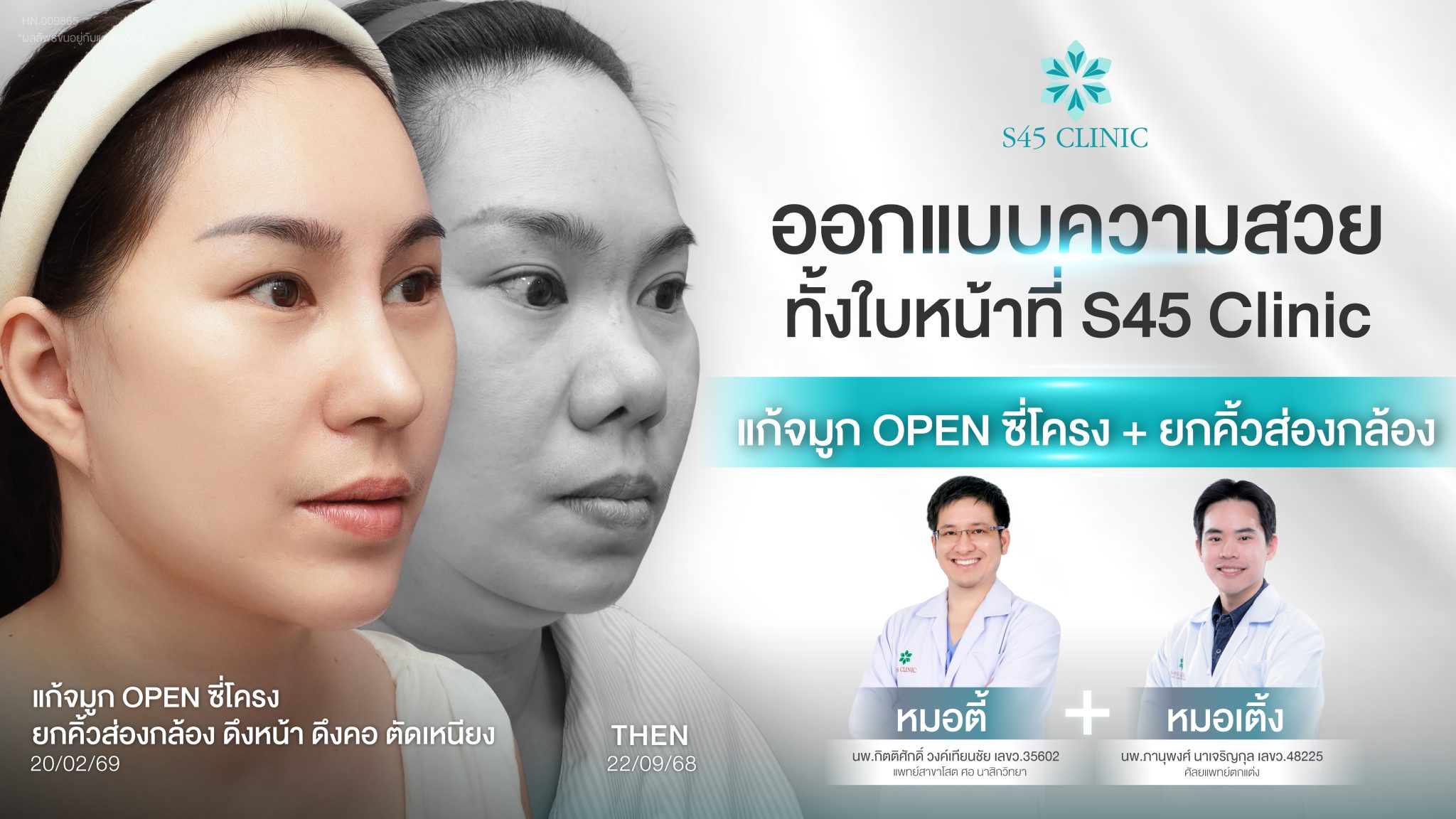 infected-nose-revision-open-rib-brow-lift-s45clinic