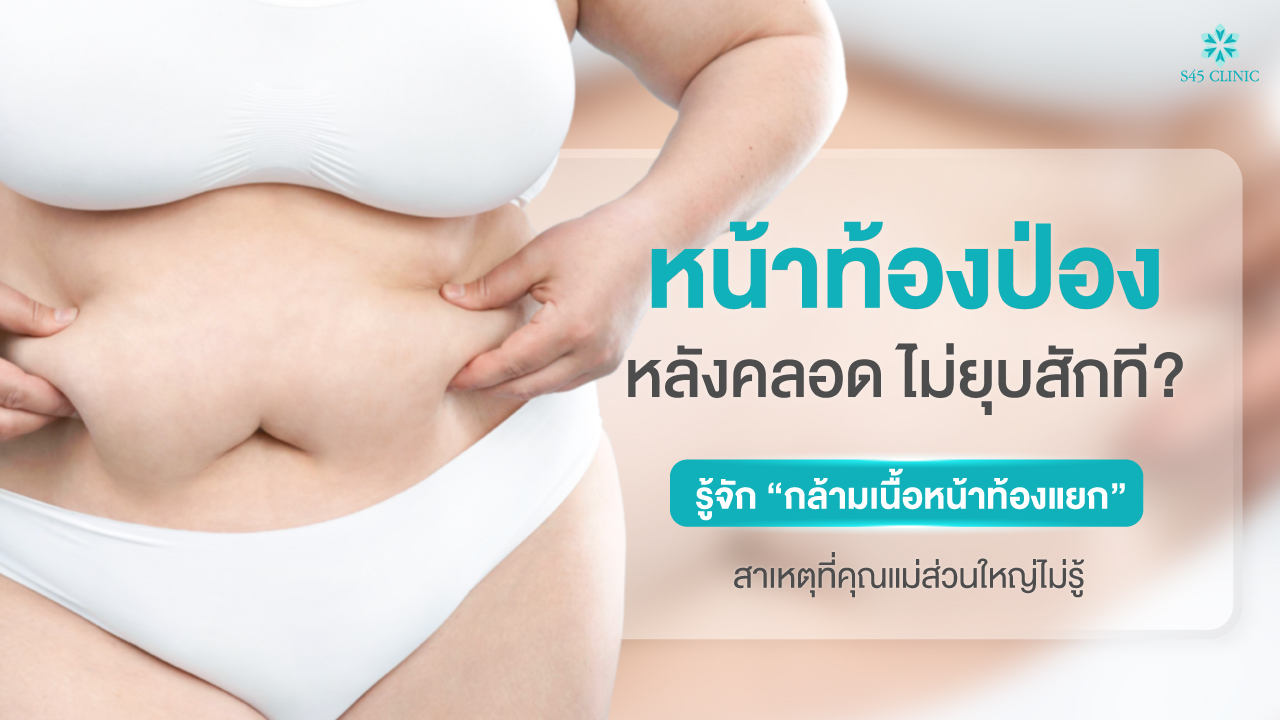 postpartum-belly-diastasis-tummy-tuck-s45
