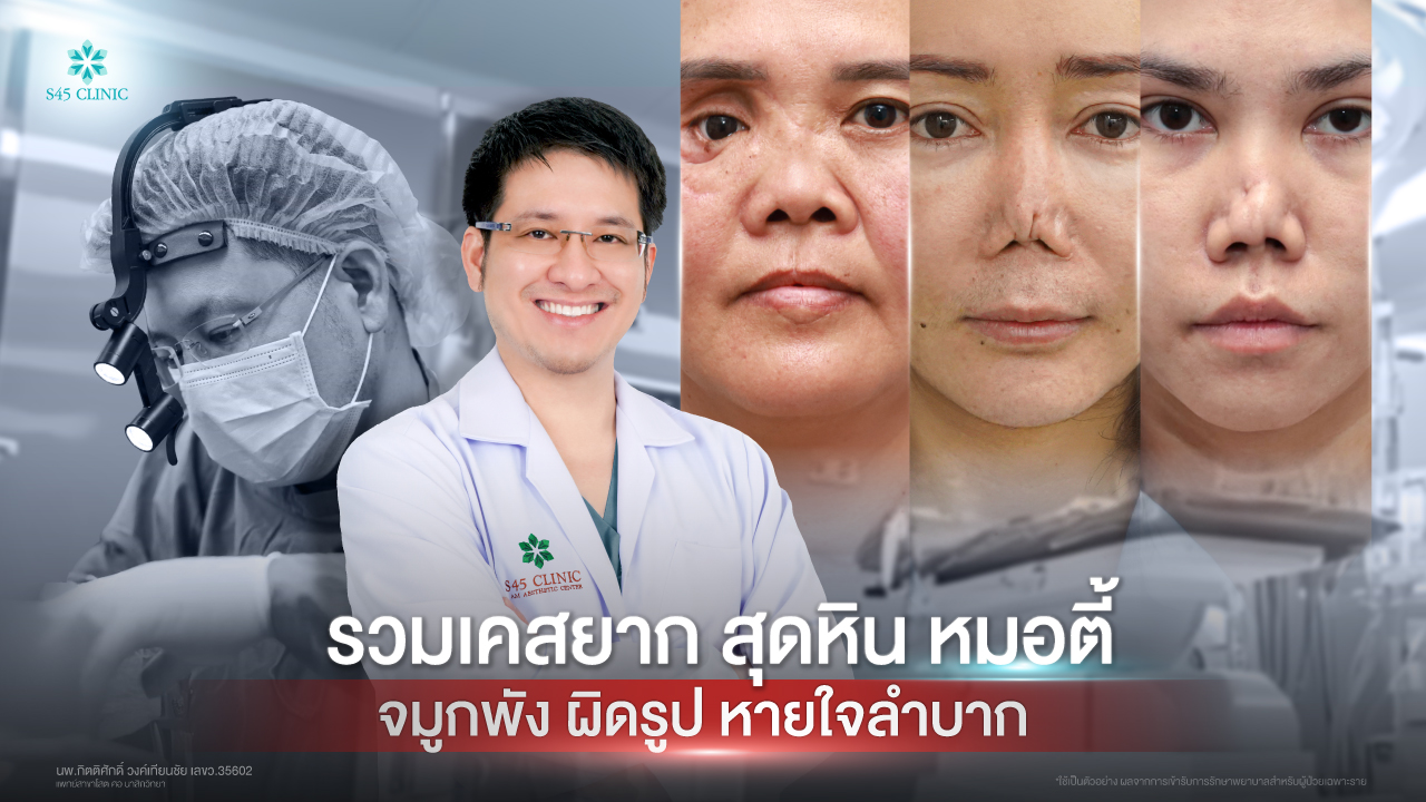 revision-rhinoplasty-complex-case-open-rib-s45-clinic