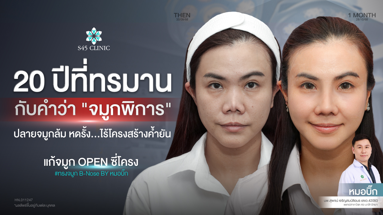 revision-rhinoplasty-severe-case-20-years-s45-clinic