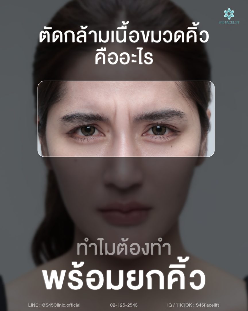 ตัดกล้ามเนื้อขมวดคิ้ว เทคนิคส่องกลล้อง 01