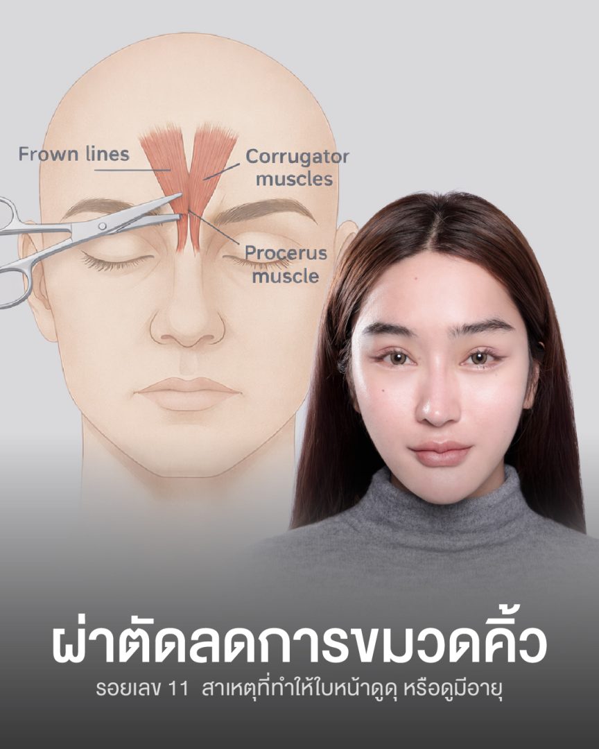 ตัดกล้ามเนื้อขมวดคิ้ว เทคนิคส่องกลล้อง 02