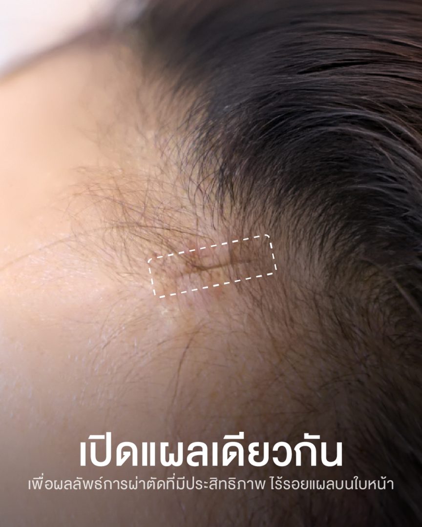 ตัดกล้ามเนื้อขมวดคิ้ว เทคนิคส่องกลล้อง 03