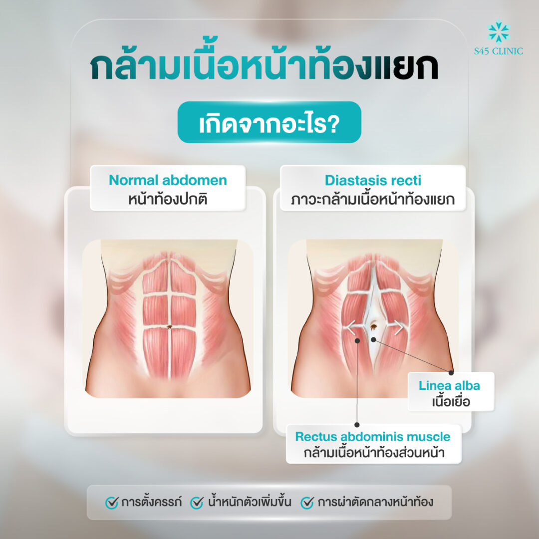 หน้าท้องป่องหลังคลอด ไม่ยุบสักที? รู้จัก “กล้ามเนื้อหน้าท้องแยก” สาเหตุที่คุณแม่ส่วนใหญ่ไม่รู้ 2 ตัดหนังหน้าท้อง S45 Clinic 02