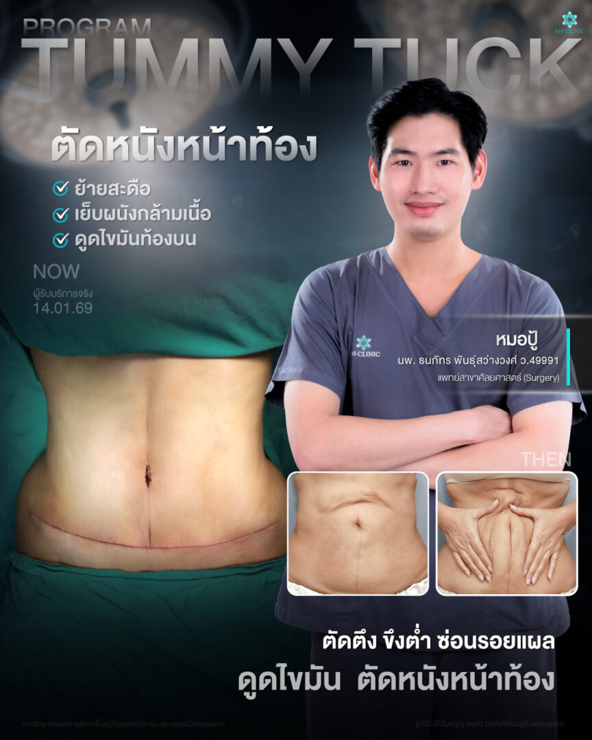 หน้าท้องป่องหลังคลอด ไม่ยุบสักที? รู้จัก “กล้ามเนื้อหน้าท้องแยก” สาเหตุที่คุณแม่ส่วนใหญ่ไม่รู้ 4 ตัดหนังหน้าท้อง S45 Clinic 04