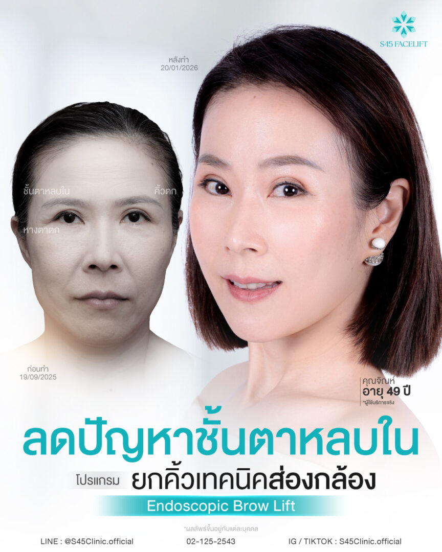 ตาสองชั้นหลบใน 08