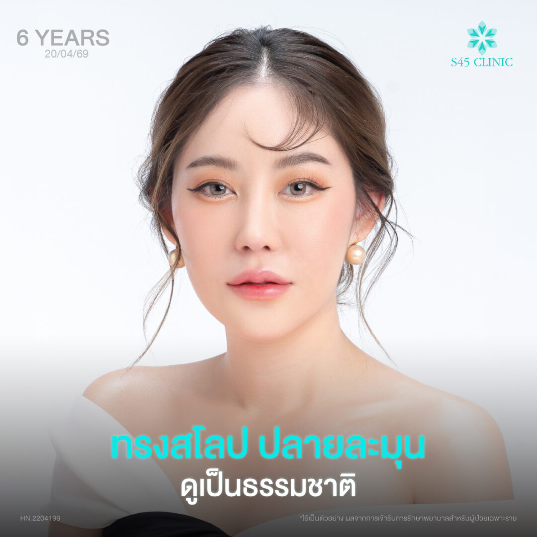 ทรงจมูก 6 ปี 01