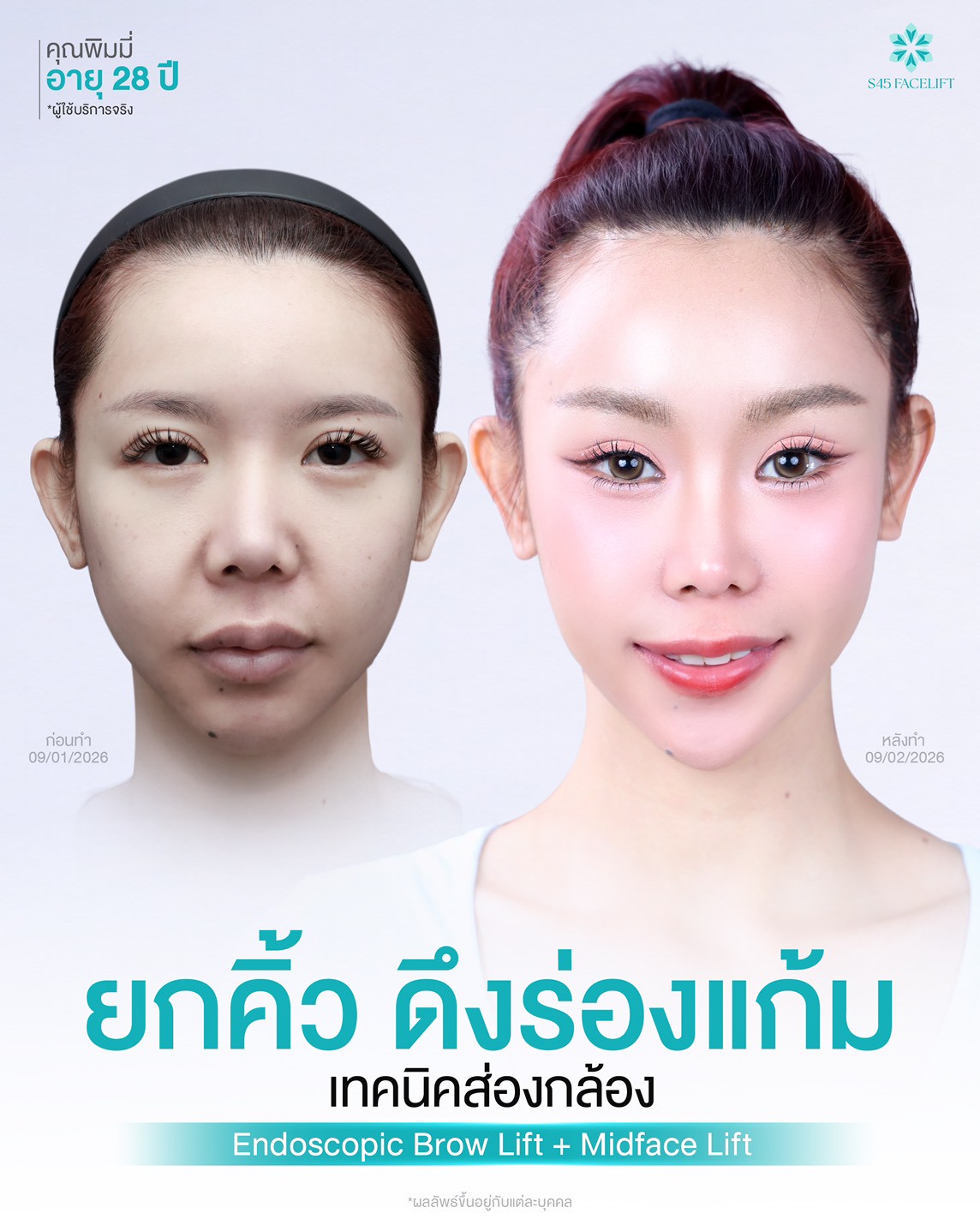 รีวิว ยกคิ้ว ดึงหน้าเทคนิคส่องกล้อง