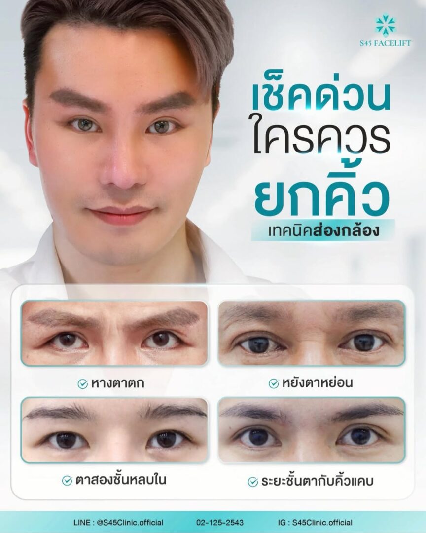 ยกคิ้ว ชั้นตาหลบใน 01