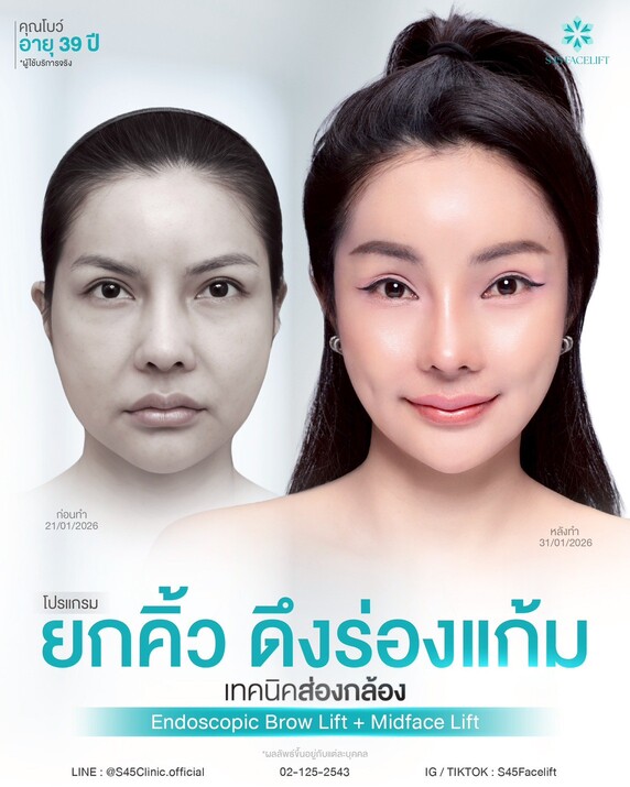 รีวิว ยกคิ้ว ดึงหน้าเทคนิคส่องกล้อง