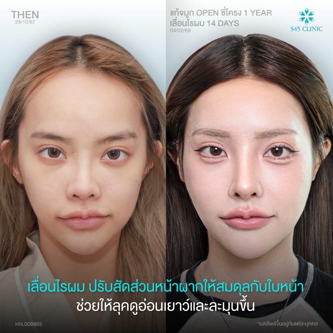 เลื่อนไรผมลด ขนาดหน้าผาก