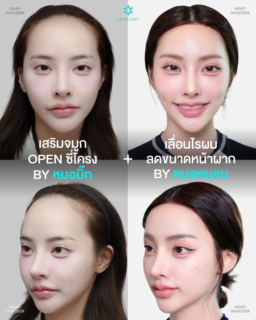 เลื่อนไรผมลด ขนาดหน้าผาก + เสริมจมูก Open ซี่โครง