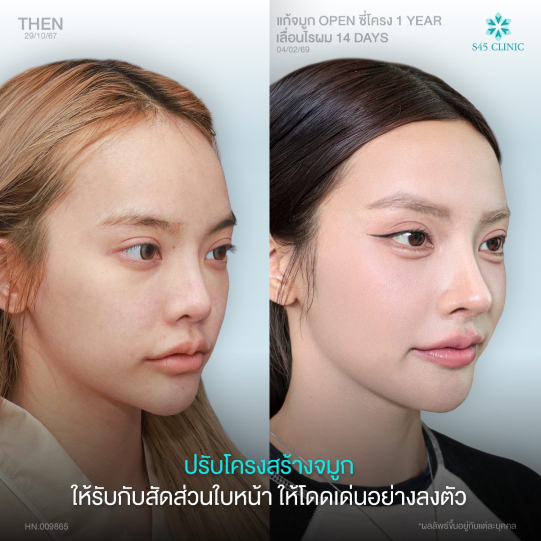 เสริมจมูก Open ซี่โครง