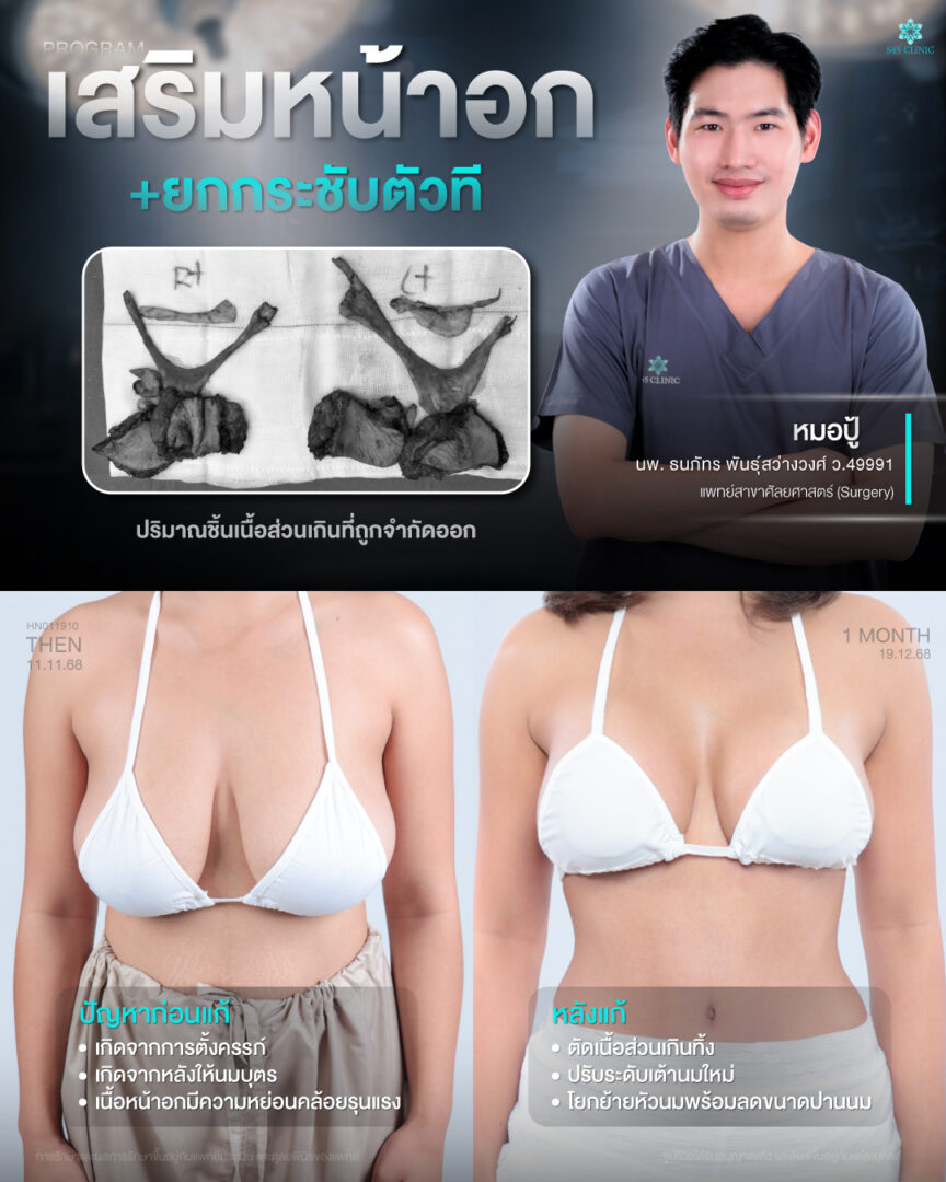 เสริมน้าอก หมอปู้ S45 Clinic 01