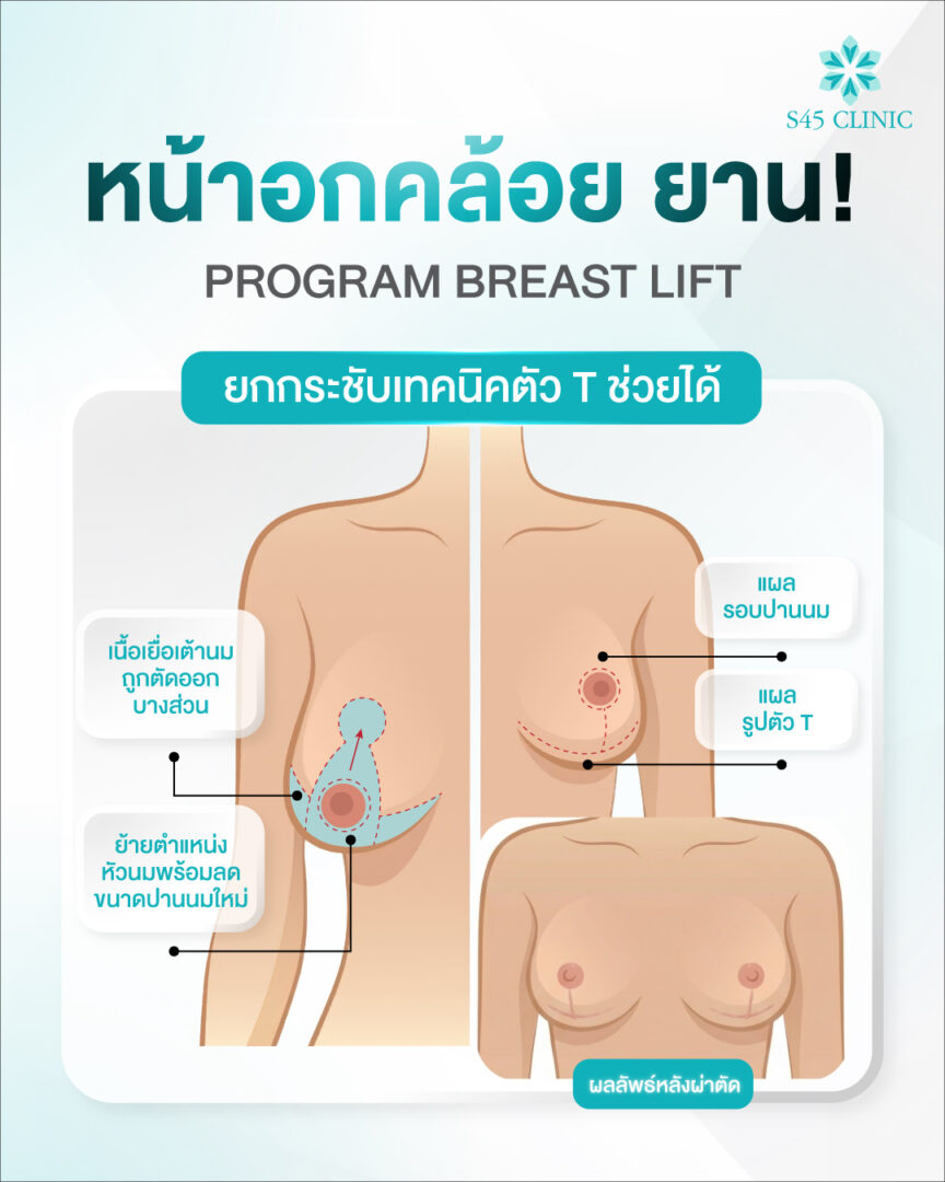 เสริมน้าอก หมอปู้ S45 Clinic 02