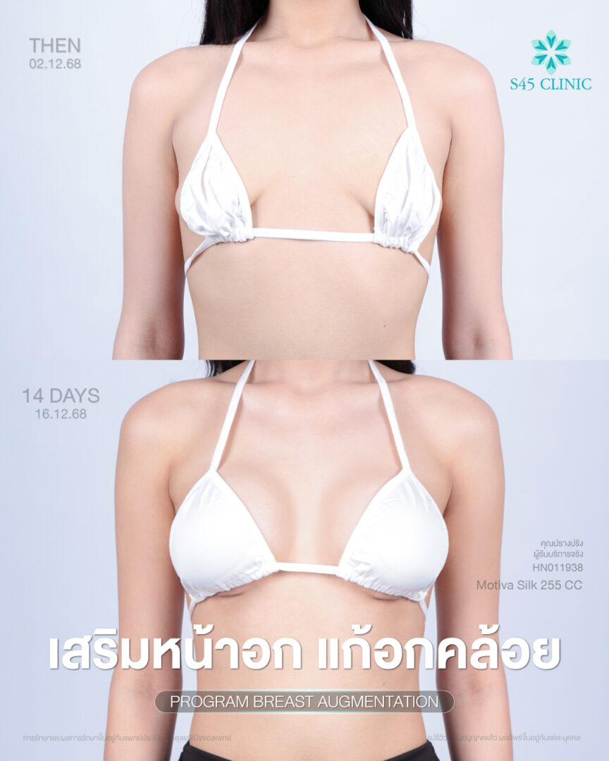 เสริมน้าอก หมอปู้ S45 Clinic 06