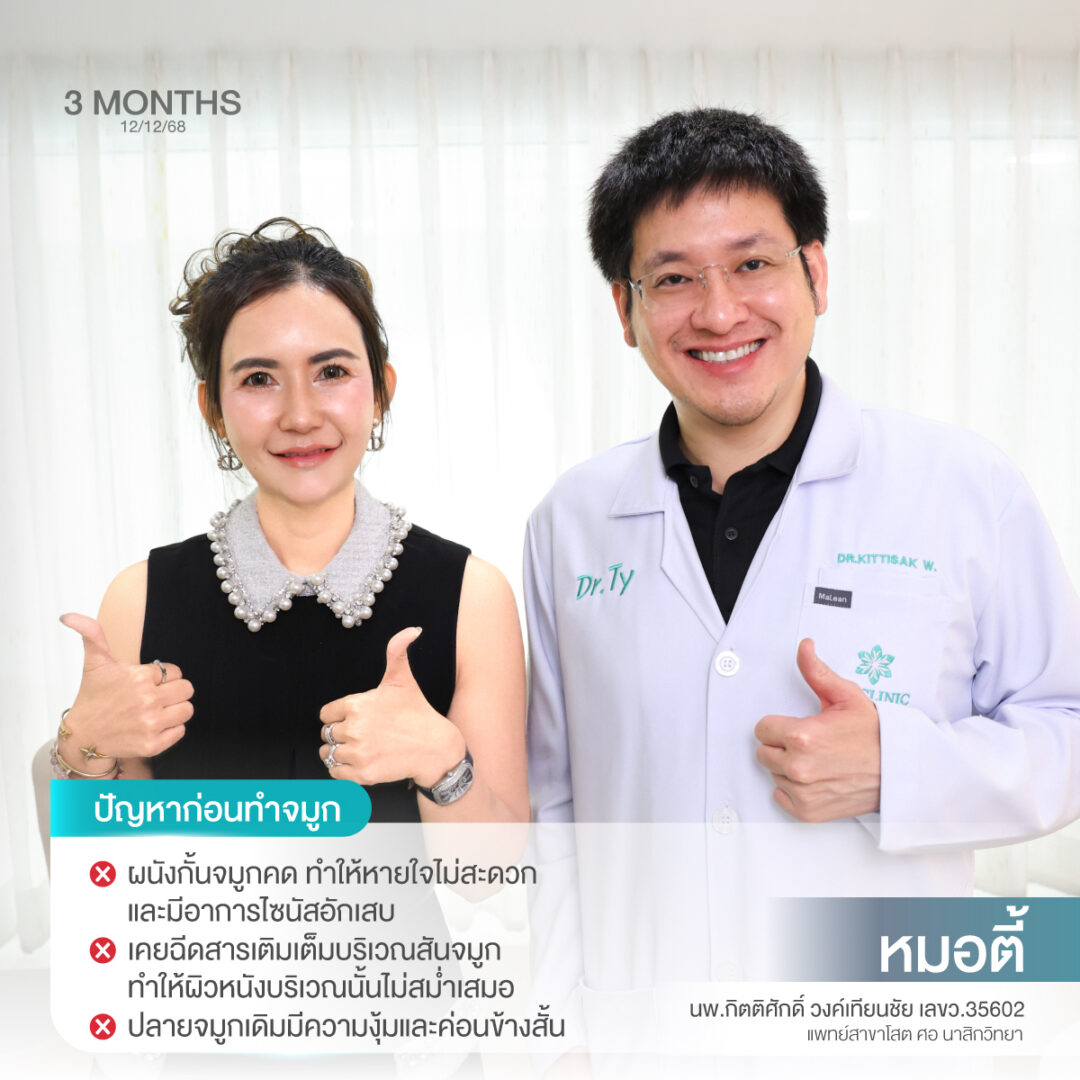 เสริมจมูก Open ซี่โครง พร้อมดูแลไซนัสและผนังจมูกคด 2 แก้จมูก หมอตี้ S45 02