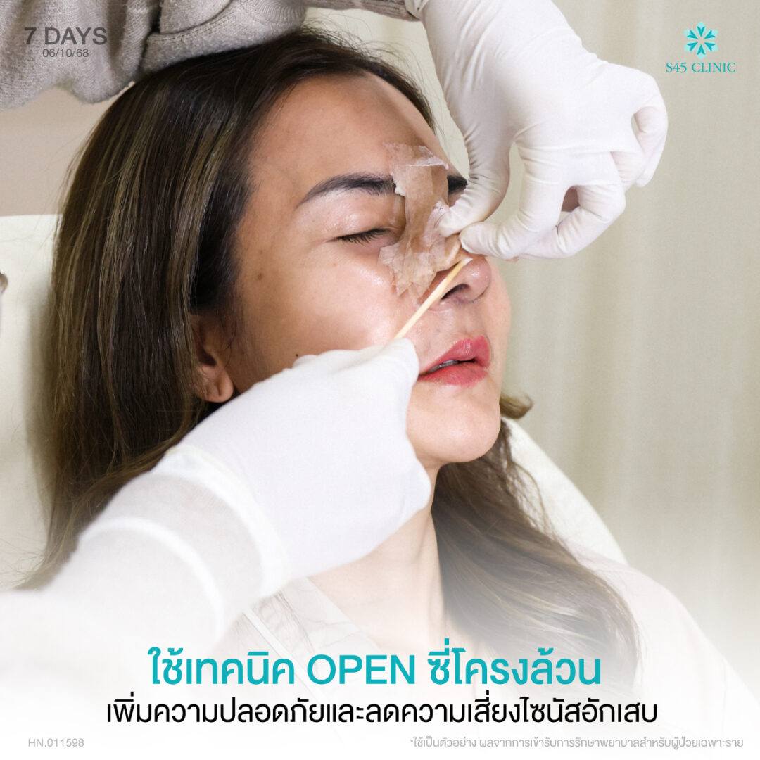 เสริมจมูก Open ซี่โครง พร้อมดูแลไซนัสและผนังจมูกคด 3 แก้จมูก หมอตี้ S45 03