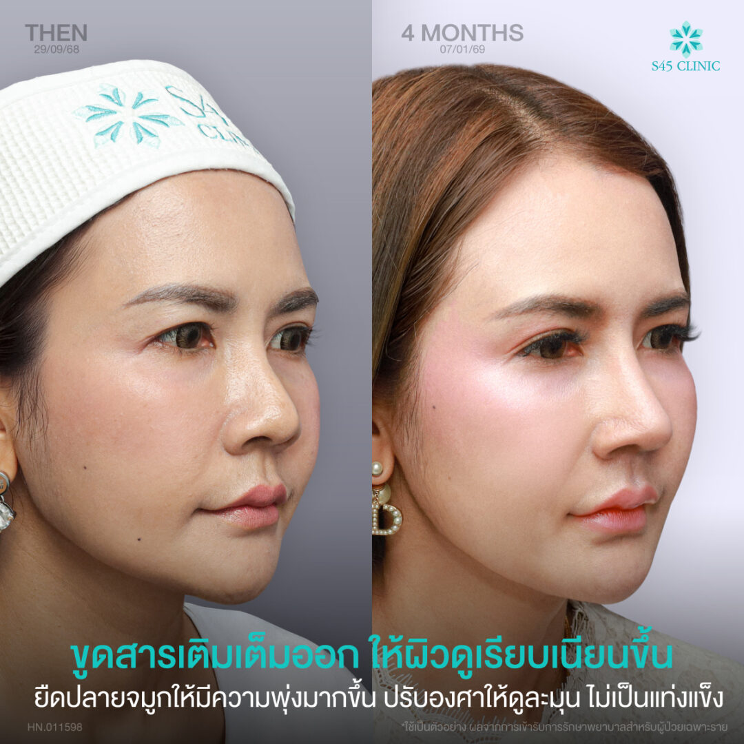 เสริมจมูก Open ซี่โครง พร้อมดูแลไซนัสและผนังจมูกคด 5 แก้จมูก หมอตี้ S45 05