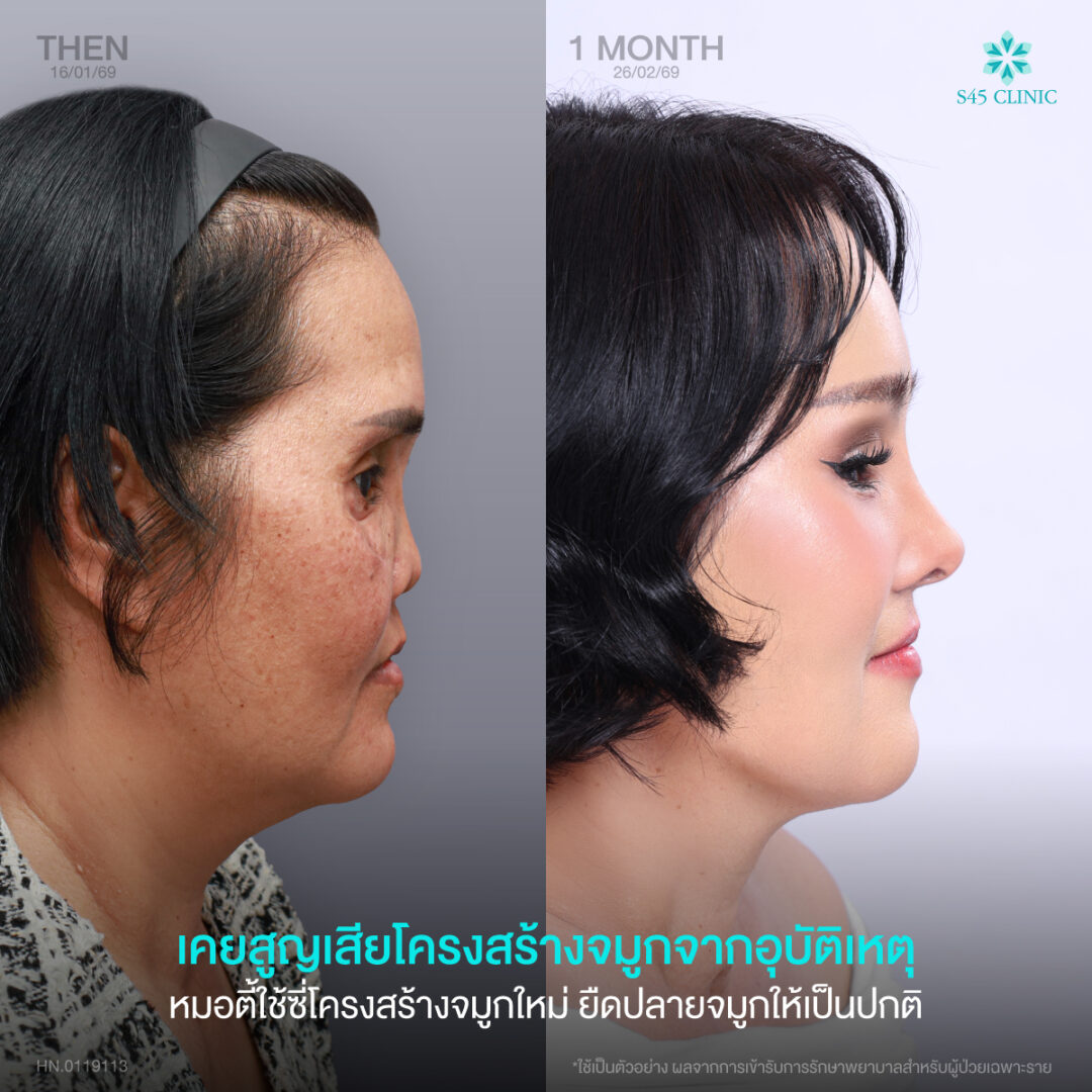 แก้จมูก เคสยาก S45 Clinic 01