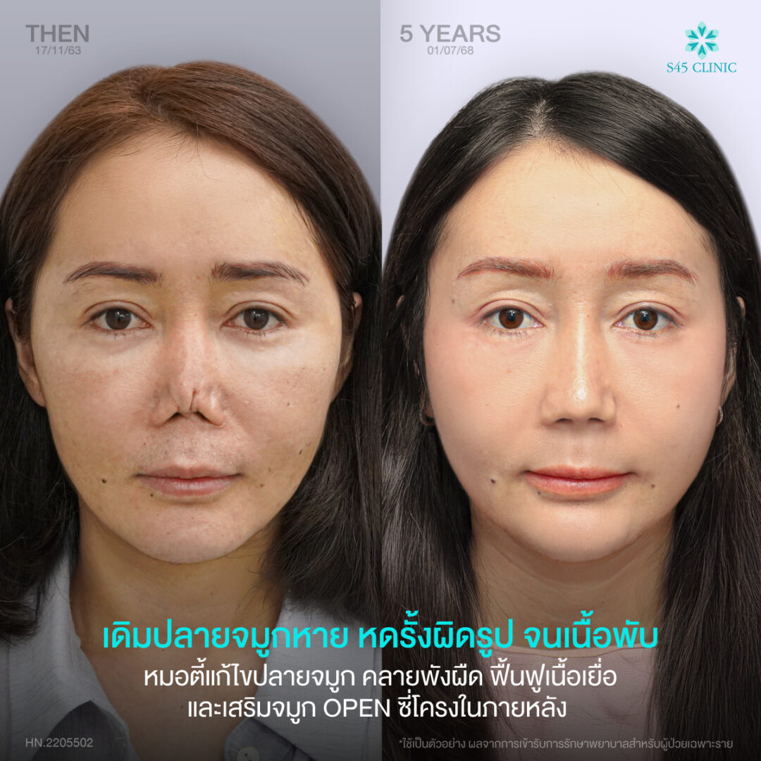 แก้จมูก เคสยาก S45 Clinic 02