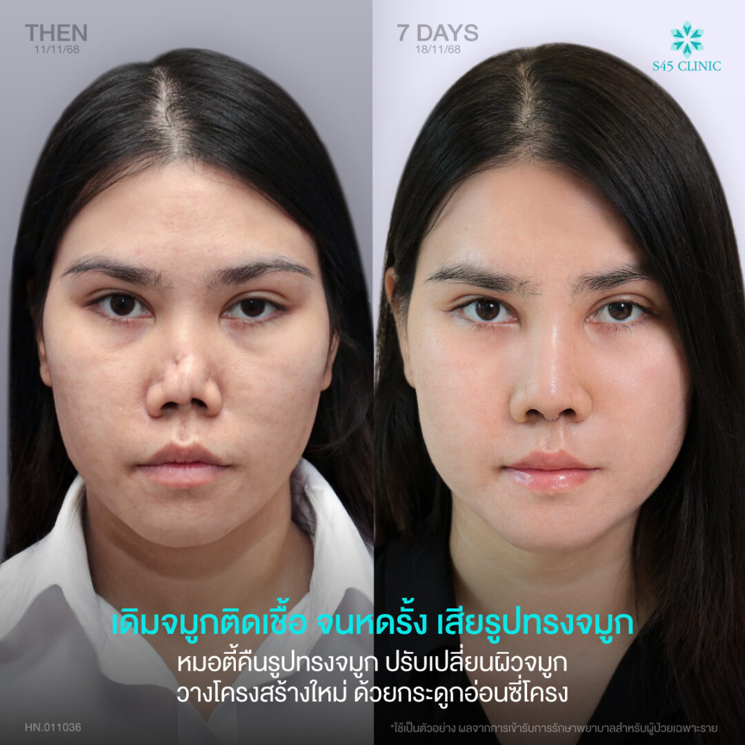 แก้จมูก เคสยาก S45 Clinic 03