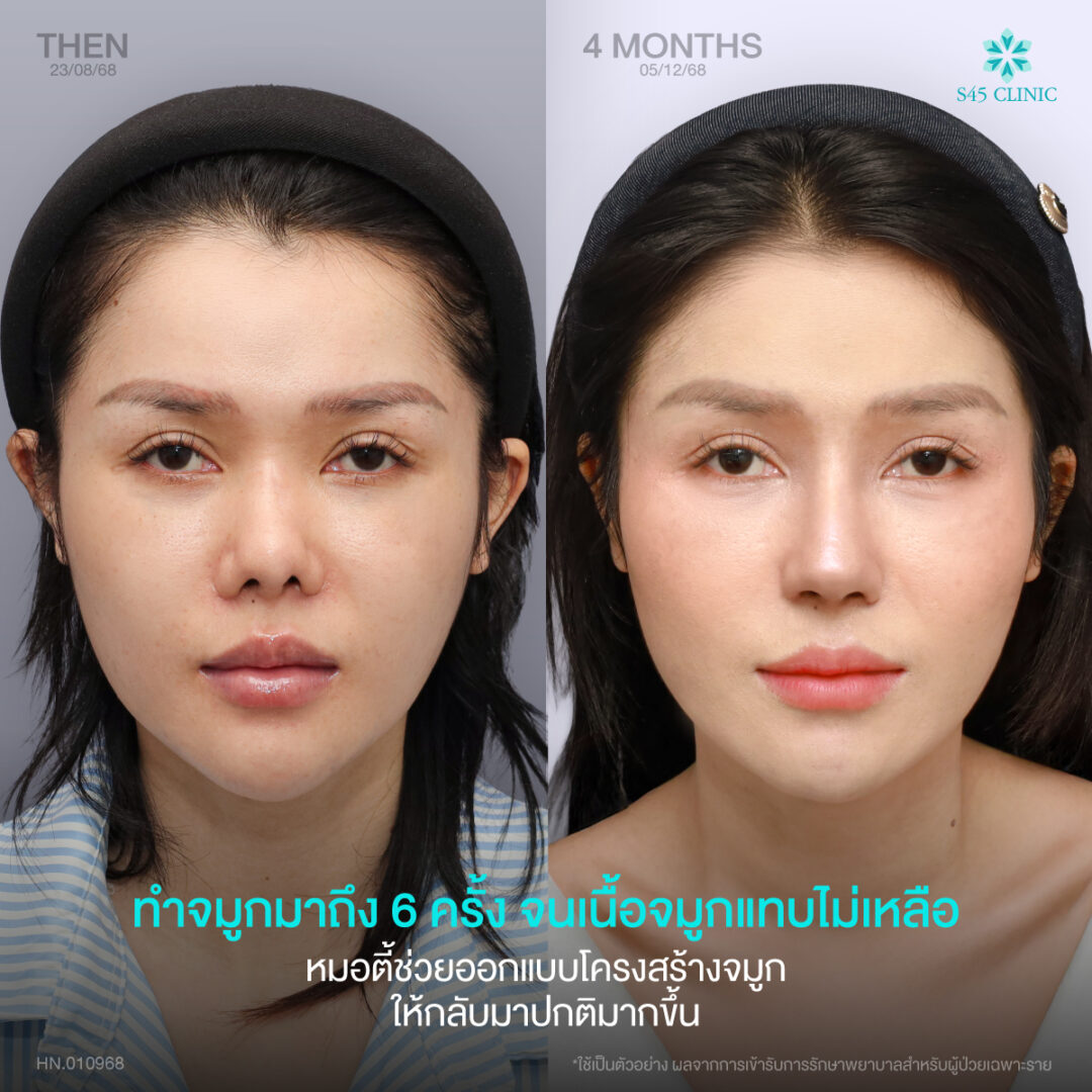 แก้จมูก เคสยาก S45 Clinic 04