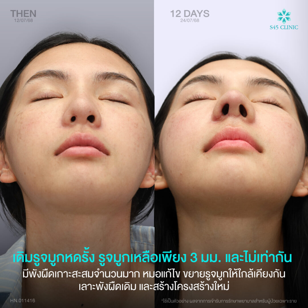 แก้จมูก เคสยาก S45 Clinic 05