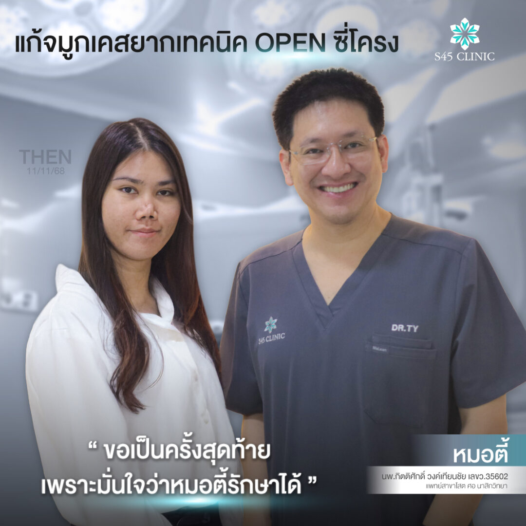 แก้จมูก เคสยาก S45 Clinic 06