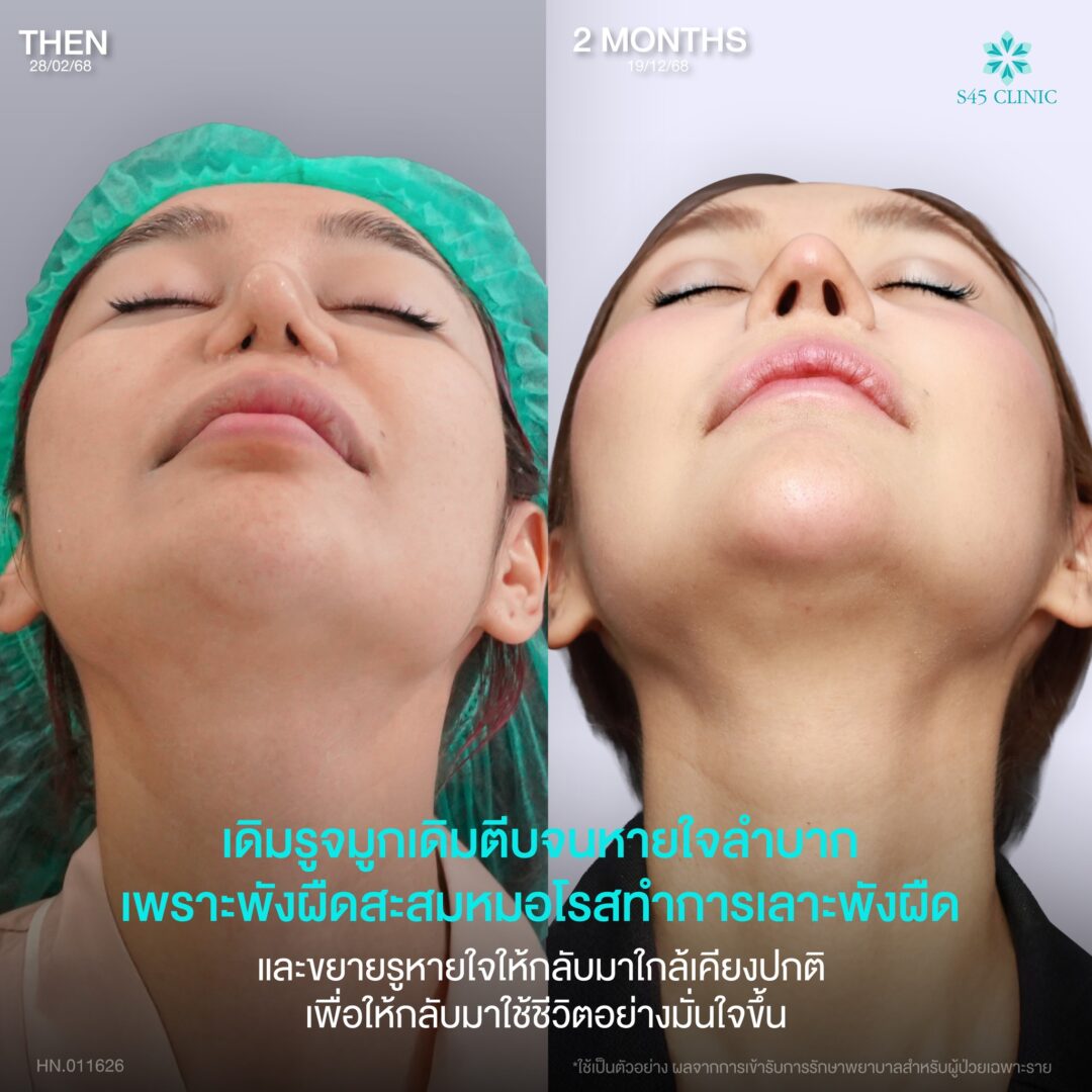 แก้จมูก เคสยาก หมอโรสS45 04