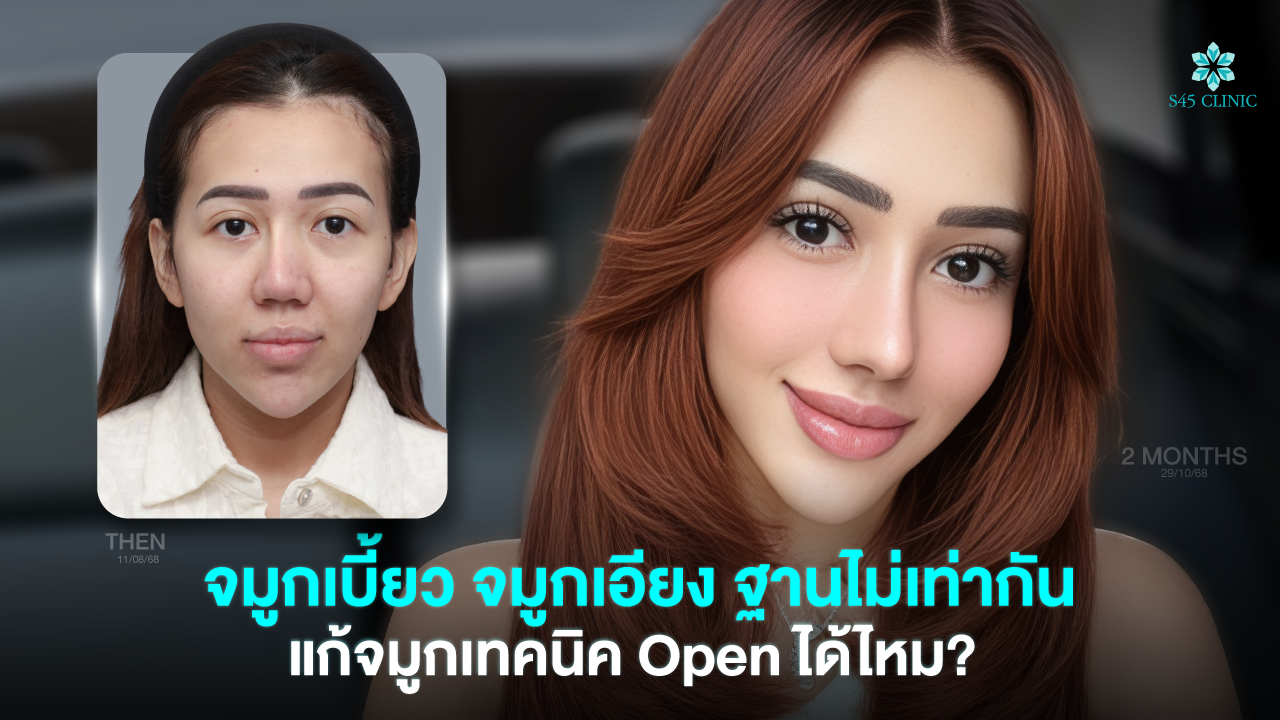 crooked-nose-after-rhinoplasty