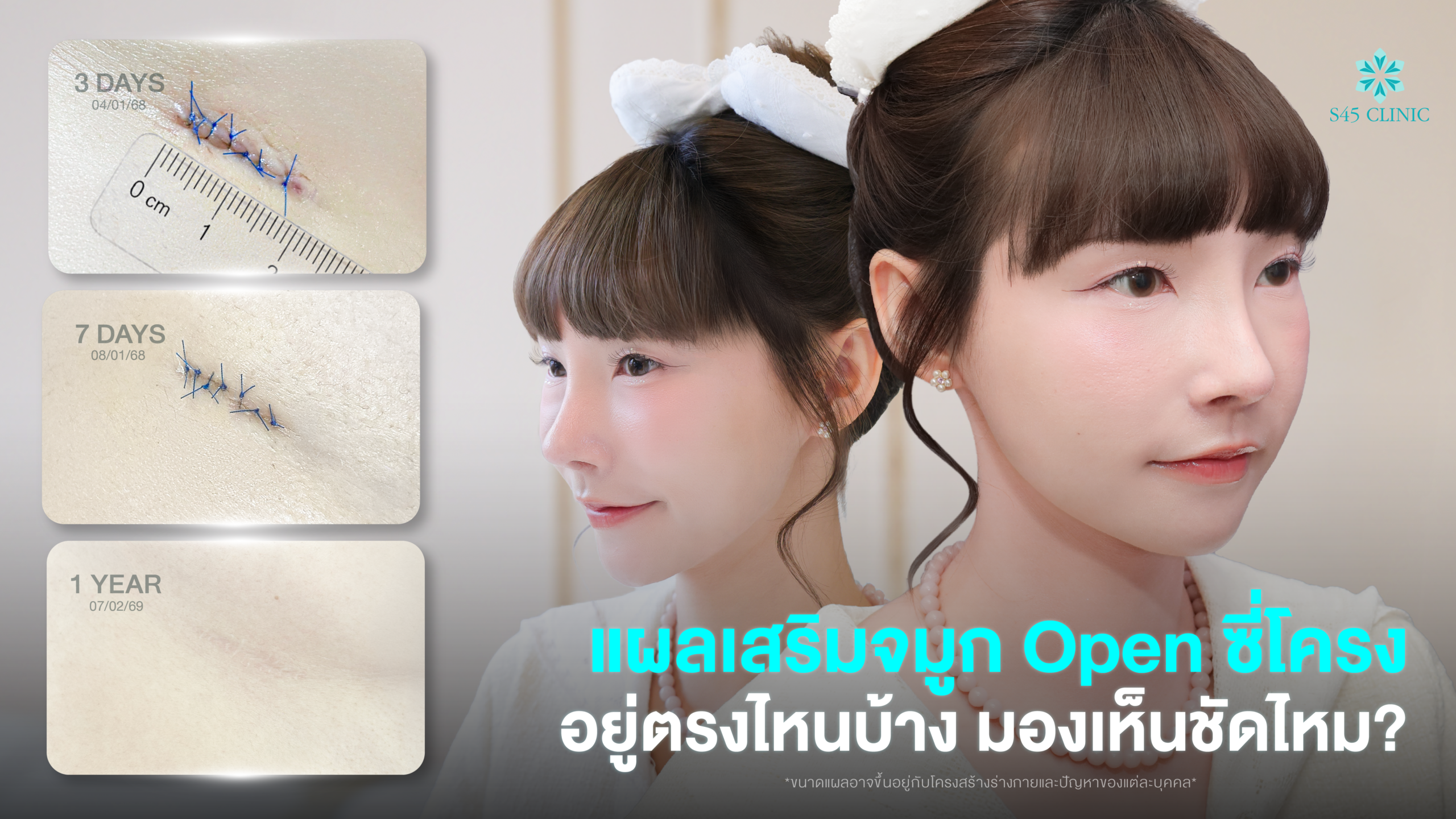 rib-rhinoplasty-scar-care