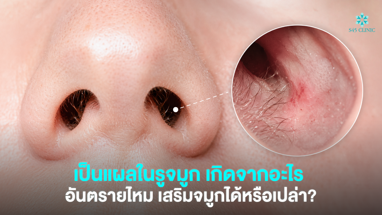 nasal-sore-rhinoplasty-keloid